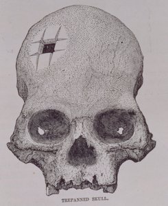 Trepanned Skull, from 